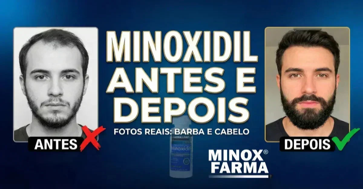 Capa do artigo mostrando a caixa de Minoxidil Kirkland e o título Antes e Depois, indicando resultados reais de barba e cabelo