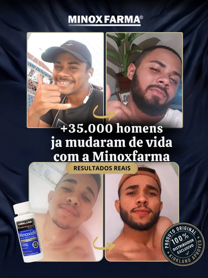 Imagem de antes e depois real de clientes MinoxFarma usando Minoxidil Kirkland, mostrando crescimento de barba após um frasco