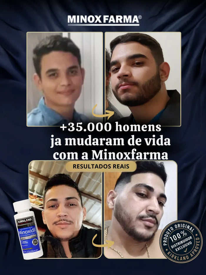 Resultados reais de clientes da MinoxFarma após o uso de 2 frascos de Minoxidil Kirkland mostrando crescimento de barba