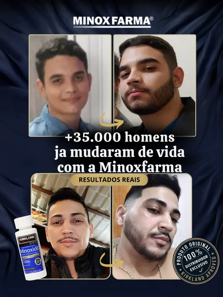 Resultados reais de clientes da MinoxFarma após o uso de 2 frascos de Minoxidil Kirkland mostrando crescimento de barba