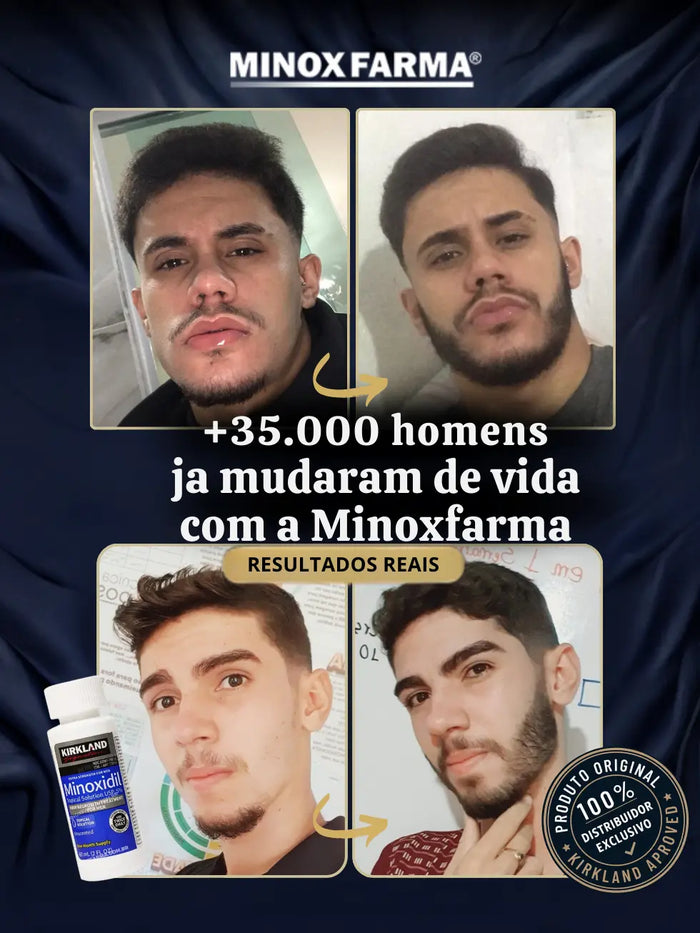 Antes e depois de clientes MinoxFarma após usarem 3 frascos de Minoxidil Kirkland, mostrando barba mais cheia e definida