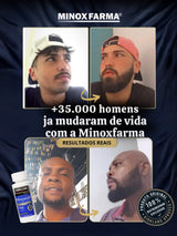 Antes e depois de clientes MinoxFarma após usarem 4 frascos de Minoxidil Kirkland, mostrando evolução significativa na barba