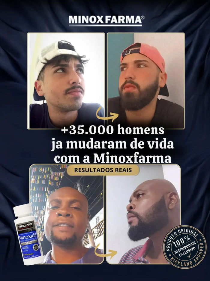 Antes e depois de clientes MinoxFarma após usarem 4 frascos de Minoxidil Kirkland, mostrando evolução significativa na barba