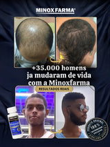 Antes e depois impressionante de clientes MinoxFarma usando o kit completo com caixa lacrada de 6 frascos de Minoxidil Kirkland e dermaroller, mostrando crescimento capilar avançado na barba e couro cabeludo