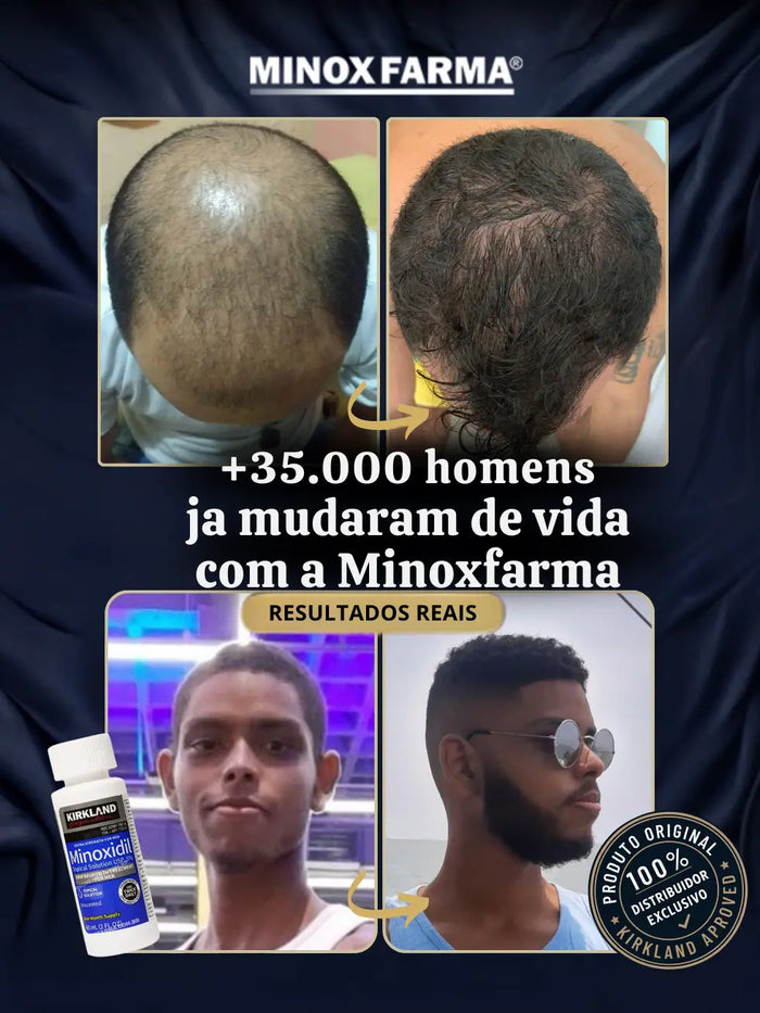 Antes e depois impressionante de clientes MinoxFarma usando o kit completo com caixa lacrada de 6 frascos de Minoxidil Kirkland e dermaroller, mostrando crescimento capilar avançado na barba e couro cabeludo